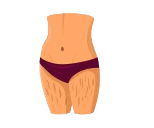 Stretch Marks