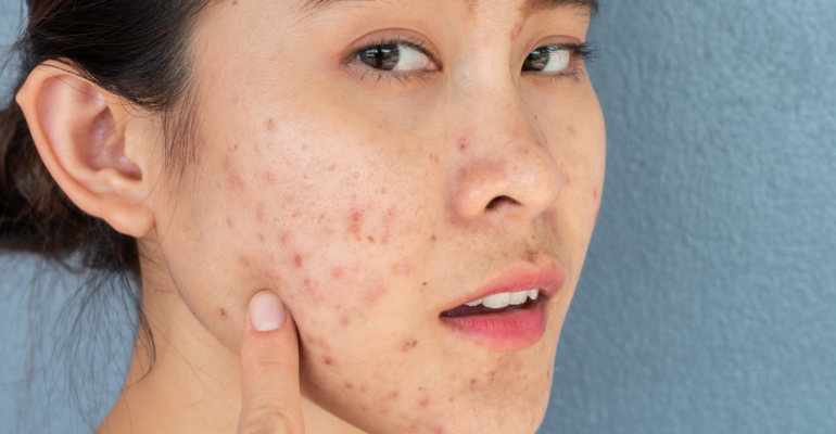 ACNE MILD