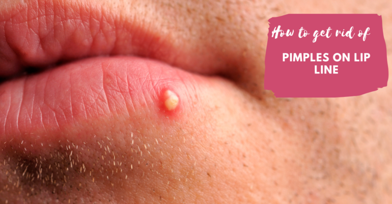 Pimples on lipline