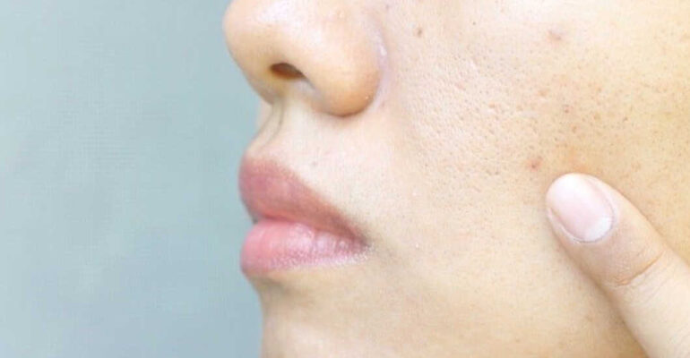 enlarged pores cheeks