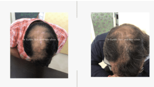 finasteride-before-and-after-1