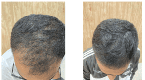 finasteride-before-and-after
