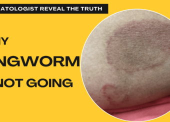 ringworm-treatment
