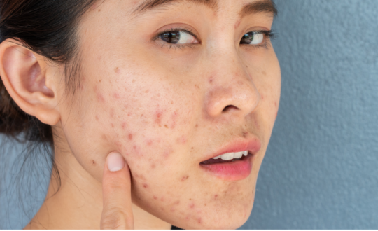 ACNE MILD