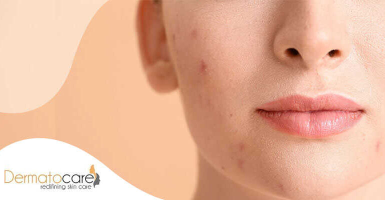 Why do adults suffer from acne?