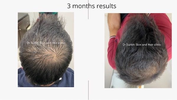 regrow hair naturally in 3 months