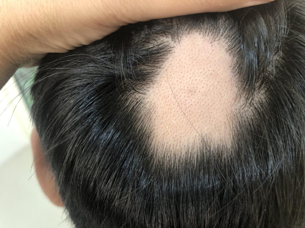  alopecia-areata