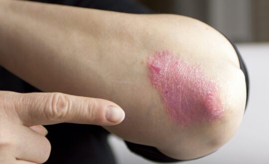 Psoriasis on elbow