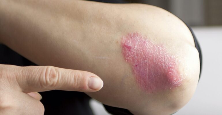 Psoriasis on elbow