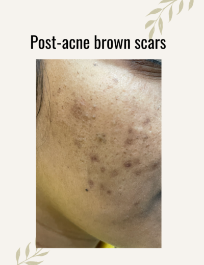 brown scar treatment