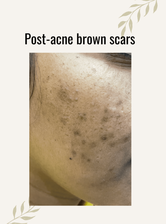 brown scar treatment