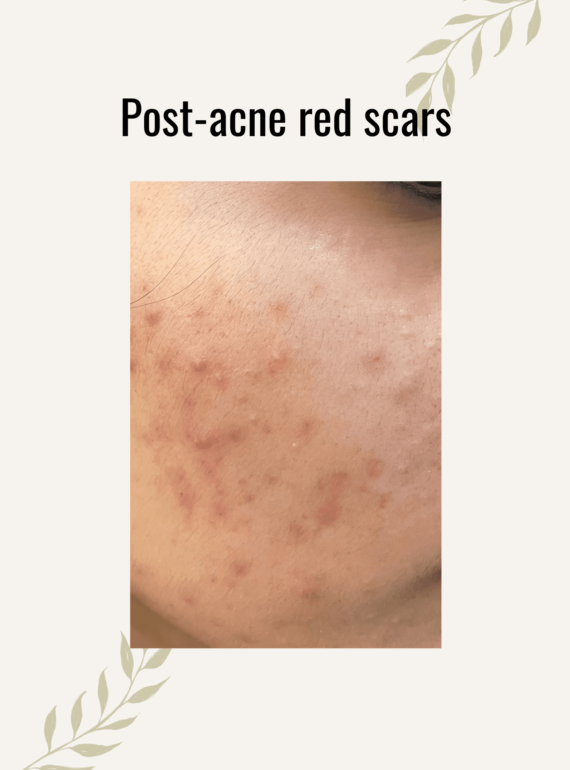 red-scar-treatment
