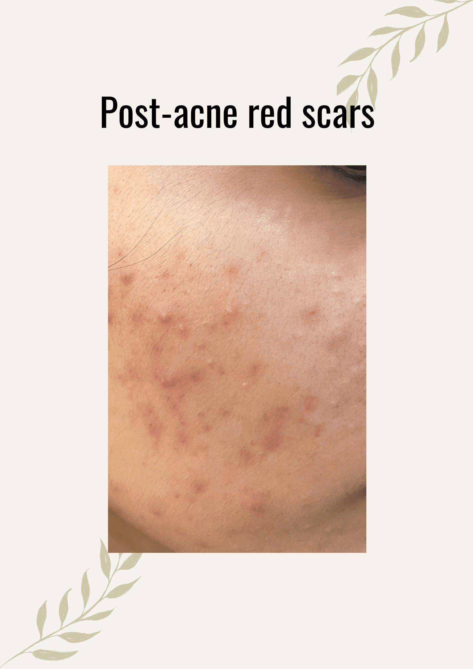 Red Acne Scars Treatment Dermatocare