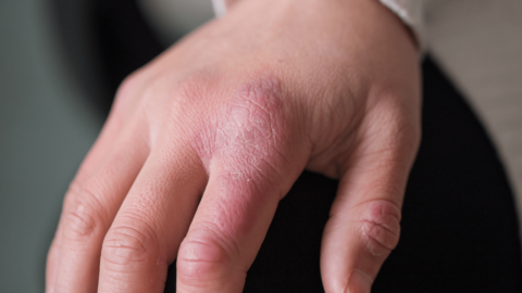 Chilblains (1)