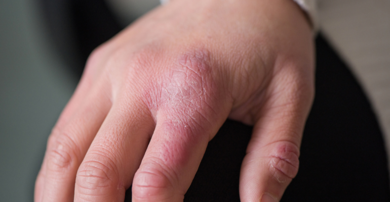 Chilblains (1)