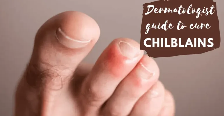 chilblains