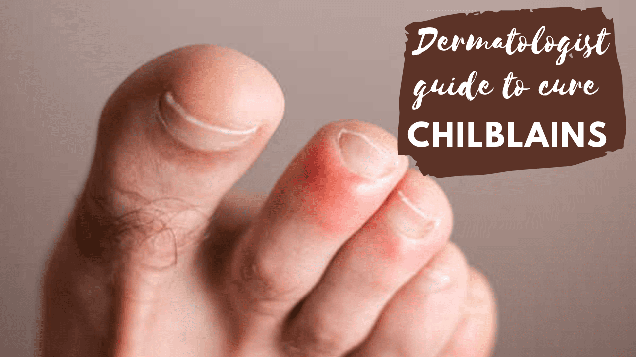 8 Natural Remedies for Chilblains that really work I Dermatologist Pick -  Dermatocare