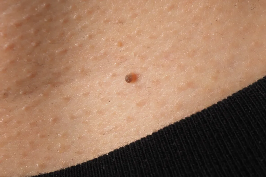 skin-tag-removal-why-and-how-to-remove-skin-tags