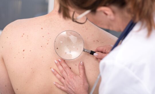 skin-cancer-screening