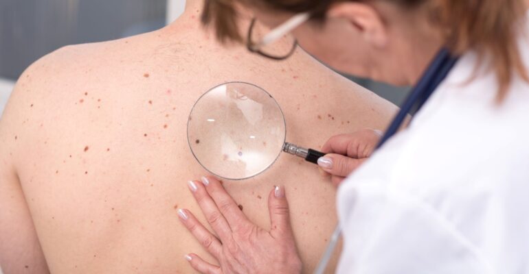 skin-cancer-screening