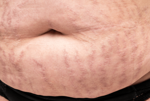 Stretch marks