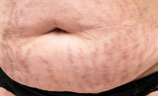 Stretch marks