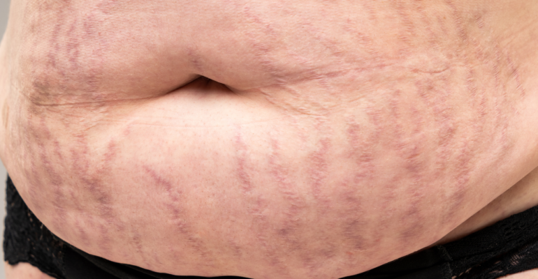 Stretch marks