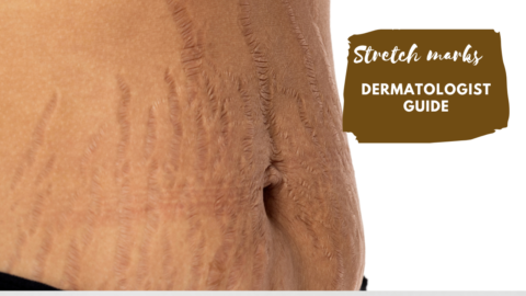 Stretch marks- dermatologist guide