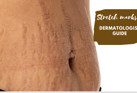 Stretch marks- dermatologist guide