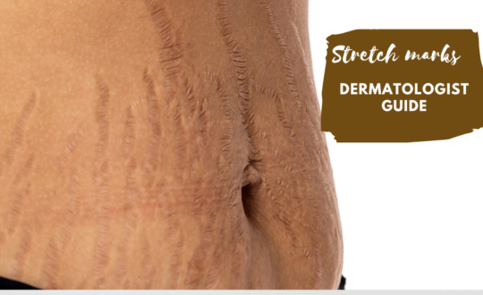 Stretch marks- dermatologist guide