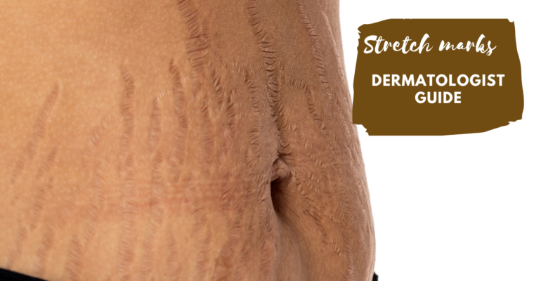 Stretch marks- dermatologist guide