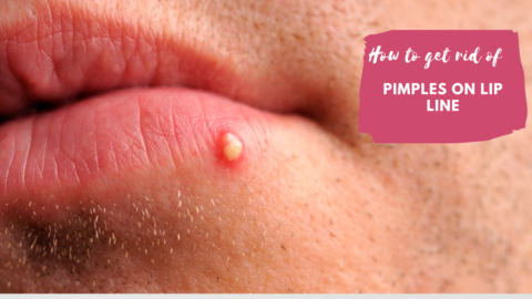 Pimples on lipline