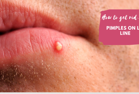 Pimples on lipline