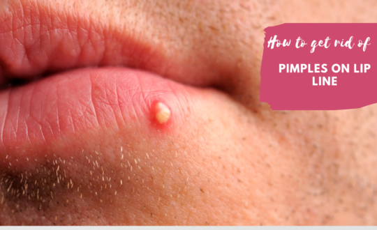 Pimples on lipline