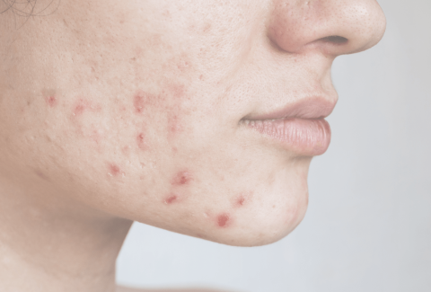 Hormonal Acne