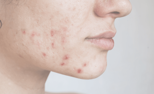 Hormonal Acne