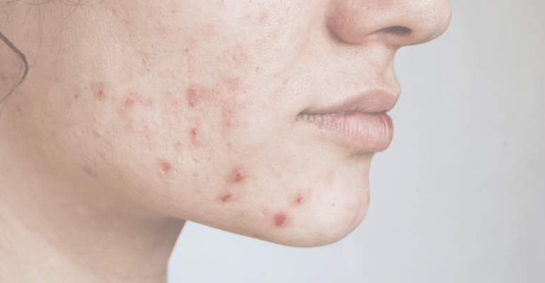 Hormonal Acne
