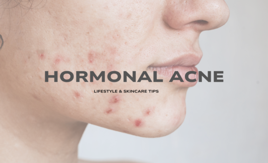 Hormonal Acne