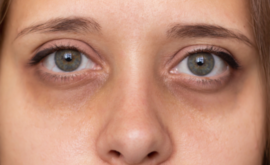 10 type pf dark circles