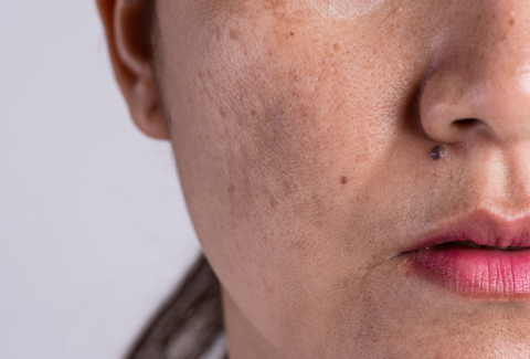MELASMA
