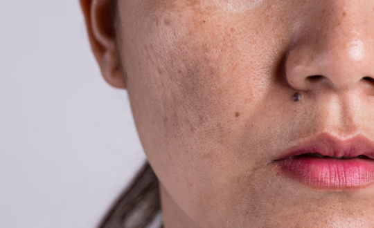 MELASMA