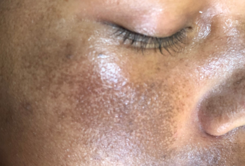 Melasma (1)