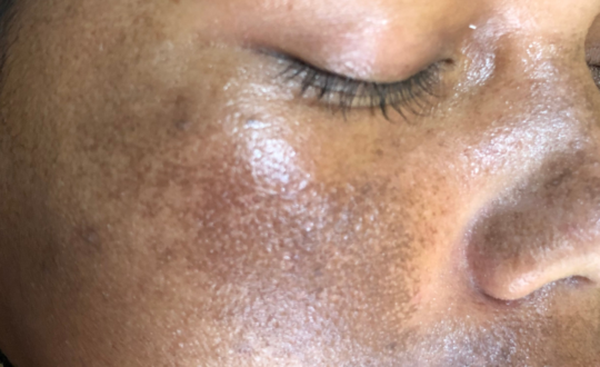 Melasma (1)