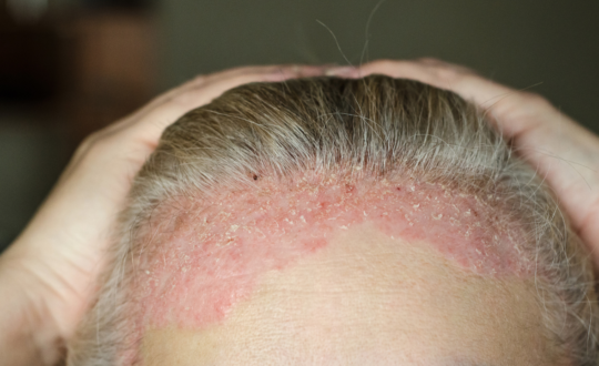 Scalp Psoriasis