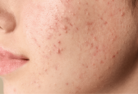 anti-acne ing