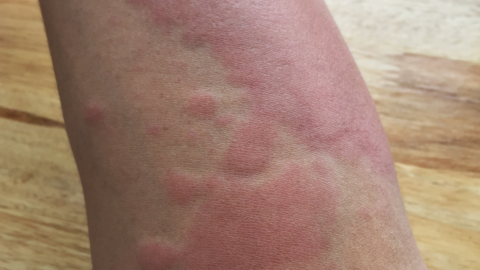 hives